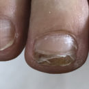 フットネイルケア　衝撃により二枚爪になってしまった爪を保護